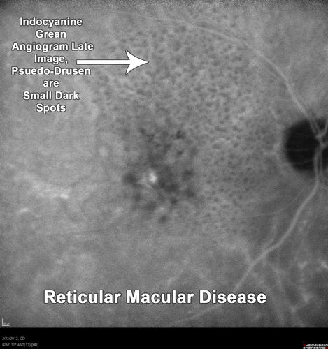 Reticular Macular Disease (Pseudo-drusen) Both Eyes - Occult CNVM and Macular Edema Right Eye 
Indocyanine Green Angiogram
