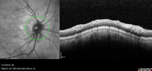 Myelinated Nerve Fiber Layer - Optic Nerve
Right eye subtle and inferior - left eye obvious
