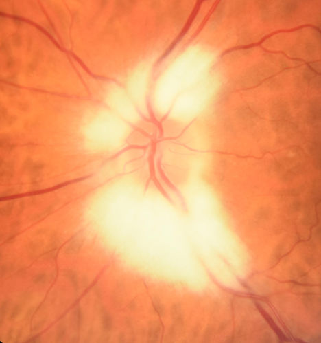 Myelinated Nerve Fiber Layer - Optic Nerve
Right eye subtle and inferior - left eye obvious
