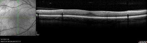Foveal Hypoplasia in adult with ROP - good Vision
26 year old female Born at 1 lb 15 oz and had cryo for ROP at birth.  
VA OD: Dcc20/25
VA OS: Dcc20/20
SD OCT shows foveal hypoplasia
The SD OCT scan shows incursion of one or more of the plexiform layers into the center of the fovea.
