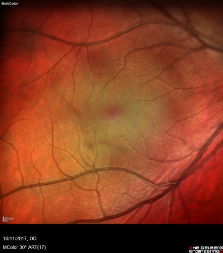 Foveal Hypoplasia in adult with ROP - good Vision
26 year old female Born at 1 lb 15 oz and had cryo for ROP at birth.  
VA OD: Dcc20/25
VA OS: Dcc20/20
SD OCT shows foveal hypoplasia
The SD OCT scan shows incursion of one or more of the plexiform layers into the center of the fovea.
