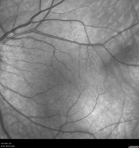 Foveal Hypoplasia in adult with ROP - good Vision
26 year old female Born at 1 lb 15 oz and had cryo for ROP at birth.  
VA OD: Dcc20/25
VA OS: Dcc20/20
SD OCT shows foveal hypoplasia
The SD OCT scan shows incursion of one or more of the plexiform layers into the center of the fovea.
