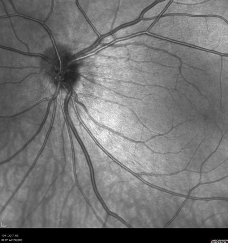 Foveal Hypoplasia in adult with ROP - good Vision
26 year old female Born at 1 lb 15 oz and had cryo for ROP at birth.  
VA OD: Dcc20/25
VA OS: Dcc20/20
SD OCT shows foveal hypoplasia
The SD OCT scan shows incursion of one or more of the plexiform layers into the center of the fovea.
