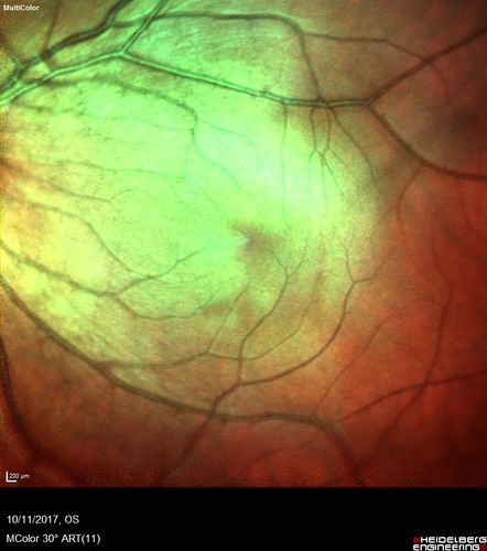 Foveal Hypoplasia in adult with ROP - good Vision
26 year old female Born at 1 lb 15 oz and had cryo for ROP at birth.  
VA OD: Dcc20/25
VA OS: Dcc20/20
SD OCT shows foveal hypoplasia
The SD OCT scan shows incursion of one or more of the plexiform layers into the center of the fovea.
