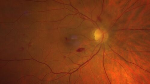 Roth Spot and Endocarditis
70 year old female - flu like symptoms with roth spot who was diagnosed by echo with endocarditis
