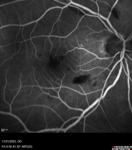 Roth Spot and Endocarditis
70 year old female - flu like symptoms with roth spot who was diagnosed by echo with endocarditis
