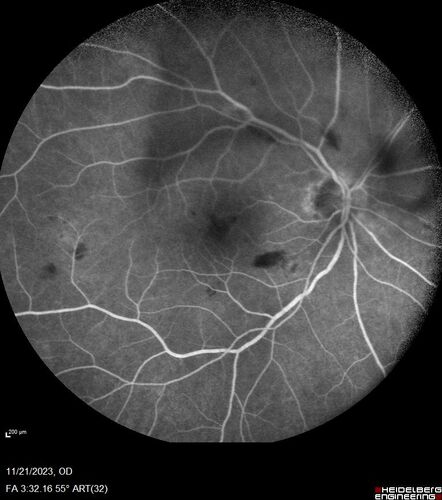 Roth Spot and Endocarditis
70 year old female - flu like symptoms with roth spot who was diagnosed by echo with endocarditis
