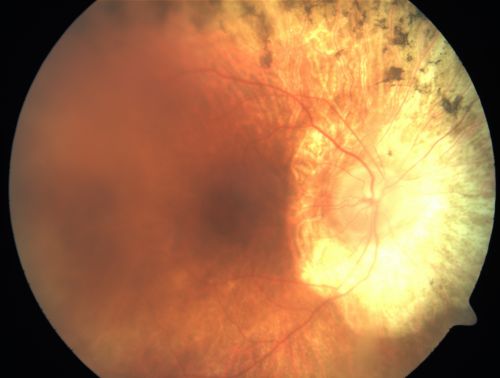 Retinitis Pigmentosa Newly Diagnosed 55 Year Old
55-year-old  noticed his vision declining recently, over the last few weeks, particularly in the right eye.  He said previous to that the vision was not normal but was pretty good.  OD is 20/100, OS is 20/50
OCT SCAN:  There is macular thickening in both eyes with intraretinal cysts.
