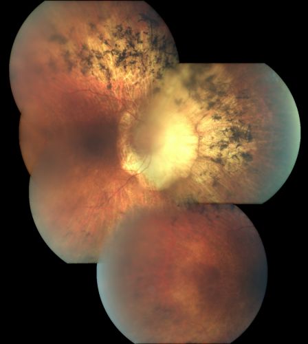 Retinitis Pigmentosa Newly Diagnosed 55 Year Old
55-year-old  noticed his vision declining recently, over the last few weeks, particularly in the right eye.  He said previous to that the vision was not normal but was pretty good.  OD is 20/100, OS is 20/50
OCT SCAN:  There is macular thickening in both eyes with intraretinal cysts.
