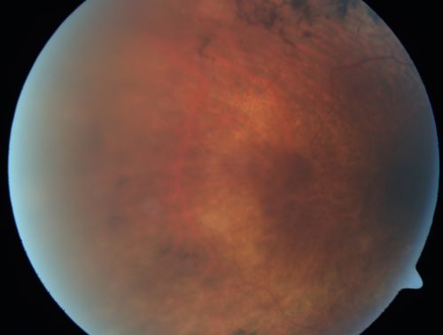 Retinitis Pigmentosa Newly Diagnosed 55 Year Old
55-year-old  noticed his vision declining recently, over the last few weeks, particularly in the right eye.  He said previous to that the vision was not normal but was pretty good.  OD is 20/100, OS is 20/50
OCT SCAN:  There is macular thickening in both eyes with intraretinal cysts.
