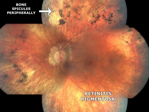 Retinitis Pigmentosa Newly Diagnosed 55 Year Old
55-year-old  noticed his vision declining recently, over the last few weeks, particularly in the right eye.  He said previous to that the vision was not normal but was pretty good.  OD is 20/100, OS is 20/50
OCT SCAN:  There is macular thickening in both eyes with intraretinal cysts.
