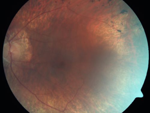 Retinitis Pigmentosa Newly Diagnosed 55 Year Old
55-year-old  noticed his vision declining recently, over the last few weeks, particularly in the right eye.  He said previous to that the vision was not normal but was pretty good.  OD is 20/100, OS is 20/50
OCT SCAN:  There is macular thickening in both eyes with intraretinal cysts.
