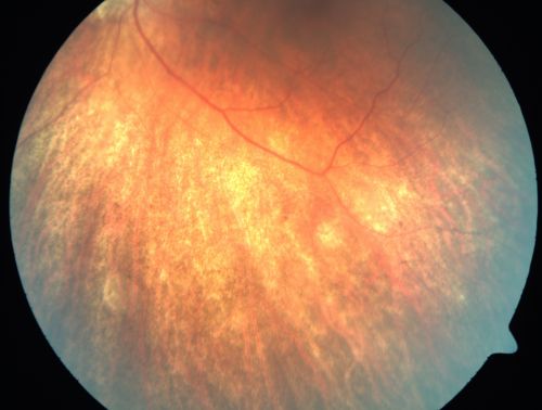 Retinitis Pigmentosa Newly Diagnosed 55 Year Old
55-year-old  noticed his vision declining recently, over the last few weeks, particularly in the right eye.  He said previous to that the vision was not normal but was pretty good.  OD is 20/100, OS is 20/50
OCT SCAN:  There is macular thickening in both eyes with intraretinal cysts.
