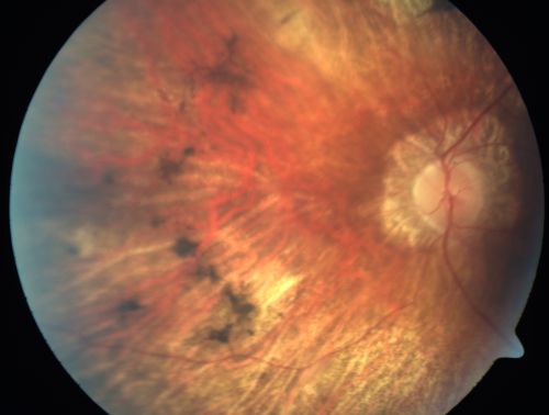 Retinitis Pigmentosa Newly Diagnosed 55 Year Old
55-year-old  noticed his vision declining recently, over the last few weeks, particularly in the right eye.  He said previous to that the vision was not normal but was pretty good.  OD is 20/100, OS is 20/50
OCT SCAN:  There is macular thickening in both eyes with intraretinal cysts.
