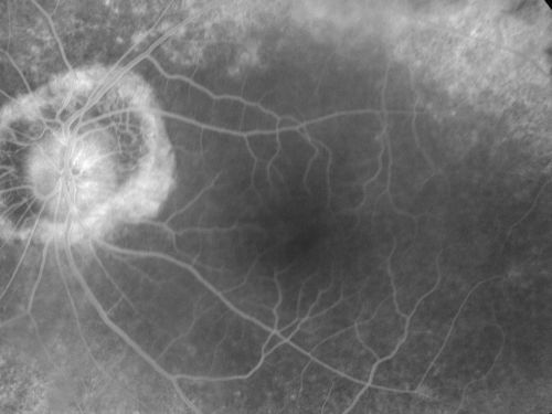 Retinitis Pigmentosa Newly Diagnosed 55 Year Old
55-year-old  noticed his vision declining recently, over the last few weeks, particularly in the right eye.  He said previous to that the vision was not normal but was pretty good.  OD is 20/100, OS is 20/50
OCT SCAN:  There is macular thickening in both eyes with intraretinal cysts.
