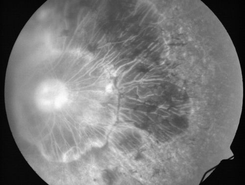 Retinitis Pigmentosa Newly Diagnosed 55 Year Old
55-year-old  noticed his vision declining recently, over the last few weeks, particularly in the right eye.  He said previous to that the vision was not normal but was pretty good.  OD is 20/100, OS is 20/50
OCT SCAN:  There is macular thickening in both eyes with intraretinal cysts.
