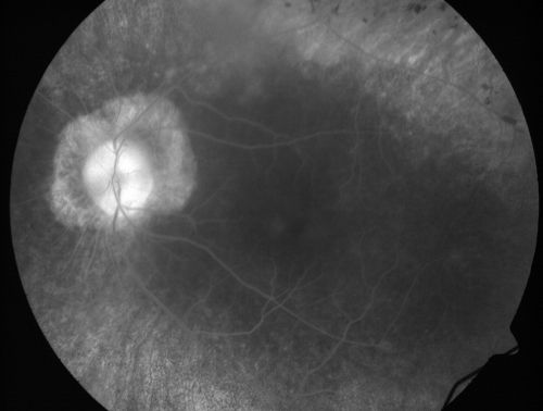 Retinitis Pigmentosa Newly Diagnosed 55 Year Old
55-year-old  noticed his vision declining recently, over the last few weeks, particularly in the right eye.  He said previous to that the vision was not normal but was pretty good.  OD is 20/100, OS is 20/50
OCT SCAN:  There is macular thickening in both eyes with intraretinal cysts.
