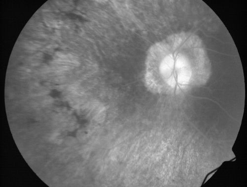 Retinitis Pigmentosa Newly Diagnosed 55 Year Old
55-year-old  noticed his vision declining recently, over the last few weeks, particularly in the right eye.  He said previous to that the vision was not normal but was pretty good.  OD is 20/100, OS is 20/50
OCT SCAN:  There is macular thickening in both eyes with intraretinal cysts.
