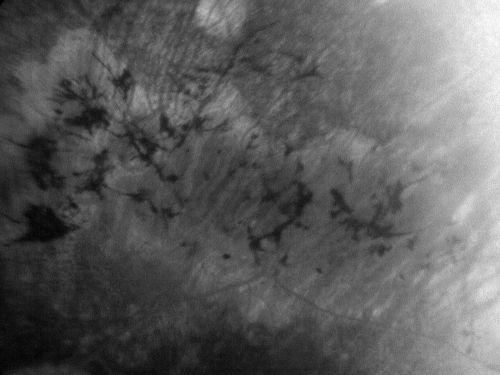 Retinitis Pigmentosa Newly Diagnosed 55 Year Old
55-year-old  noticed his vision declining recently, over the last few weeks, particularly in the right eye.  He said previous to that the vision was not normal but was pretty good.  OD is 20/100, OS is 20/50
OCT SCAN:  There is macular thickening in both eyes with intraretinal cysts.
