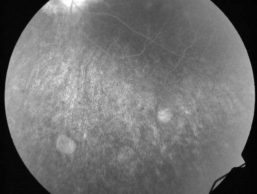 Retinitis Pigmentosa Newly Diagnosed 55 Year Old
55-year-old  noticed his vision declining recently, over the last few weeks, particularly in the right eye.  He said previous to that the vision was not normal but was pretty good.  OD is 20/100, OS is 20/50
OCT SCAN:  There is macular thickening in both eyes with intraretinal cysts.
