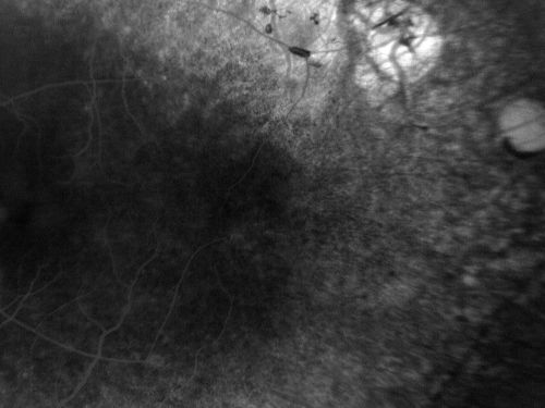 Retinitis Pigmentosa Newly Diagnosed 55 Year Old
55-year-old  noticed his vision declining recently, over the last few weeks, particularly in the right eye.  He said previous to that the vision was not normal but was pretty good.  OD is 20/100, OS is 20/50
OCT SCAN:  There is macular thickening in both eyes with intraretinal cysts.
