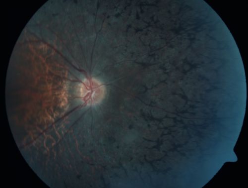 Retinitis Pigmentosa 32 Year Old Woman - 20/25 vision both eyes
32-year-old woman was seen in the office on 6/26/2009.  She has had retinitis pigmentosa since 2003.    She has difficulty with night vision but overall she is doing pretty well.
Vision OU is 20/25. 
