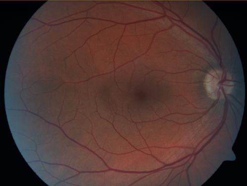 Retinal Pigment Epithelial Dysgenesis
