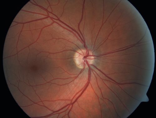 Retinal Pigment Epithelial Dysgenesis
