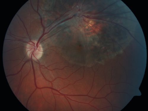 Retinal Pigment Epithelial Dysgenesis
