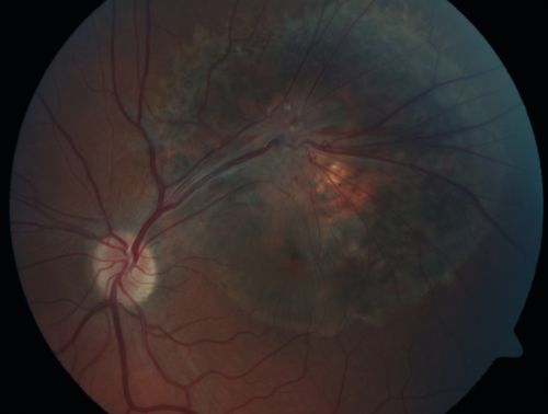 Retinal Pigment Epithelial Dysgenesis
