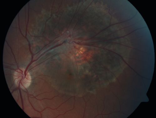 Retinal Pigment Epithelial Dysgenesis
