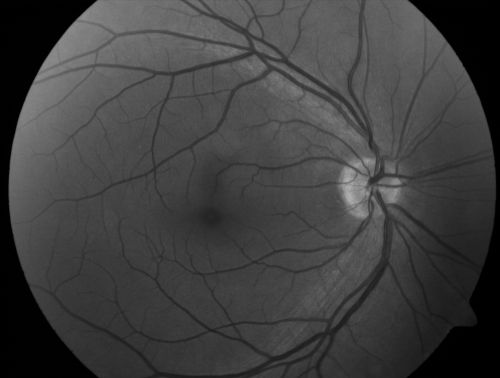 Retinal Pigment Epithelial Dysgenesis
