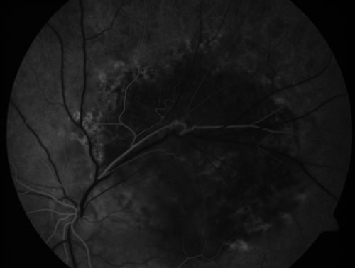 Retinal Pigment Epithelial Dysgenesis
