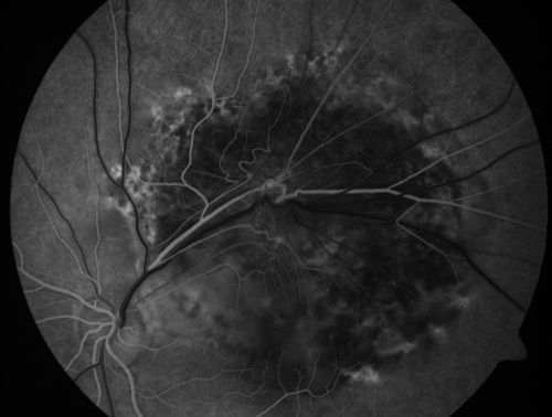 Retinal Pigment Epithelial Dysgenesis
