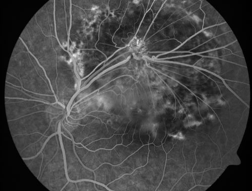 Retinal Pigment Epithelial Dysgenesis
