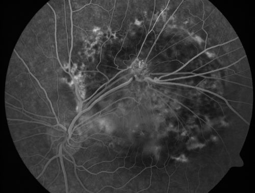 Retinal Pigment Epithelial Dysgenesis
