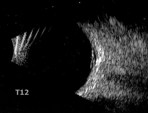 Retinal Pigment Epithelial Dysgenesis
