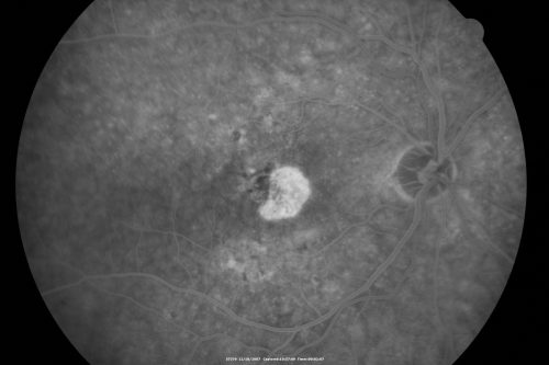 Small Retinal Pigment Epithelial Rip and Poor Vision (20/400)
80-year-old woman vision in the right eye has substantially declined.  
  OD:  20/400;  OS:  20/50
