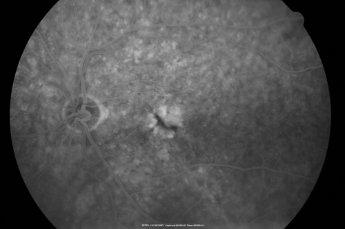 Small Retinal Pigment Epithelial Rip and Poor Vision (20/400)
80-year-old woman vision in the right eye has substantially declined.  
  OD:  20/400;  OS:  20/50
