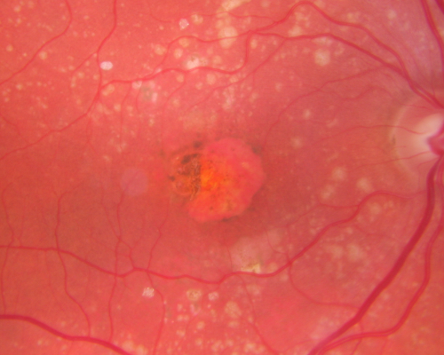 Small Retinal Pigment Epithelial Rip and Poor Vision (20/400)
80-year-old woman vision in the right eye has substantially declined.  
  OD:  20/400;  OS:  20/50
