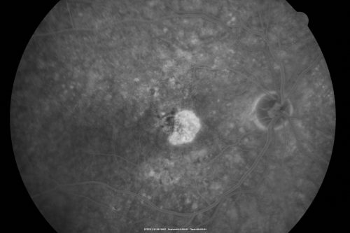 Small Retinal Pigment Epithelial Rip and Poor Vision (20/400)
80-year-old woman vision in the right eye has substantially declined.  
  OD:  20/400;  OS:  20/50

