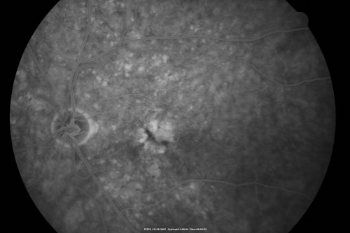 Small Retinal Pigment Epithelial Rip and Poor Vision (20/400)
80-year-old woman vision in the right eye has substantially declined.  
  OD:  20/400;  OS:  20/50
