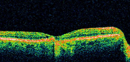 Small Retinal Pigment Epithelial Rip and Poor Vision (20/400)
80-year-old woman vision in the right eye has substantially declined.  
  OD:  20/400;  OS:  20/5080-year-old woman vision in the right eye has substantially declined.  
  OD:  20/400;  OS:  20/50

