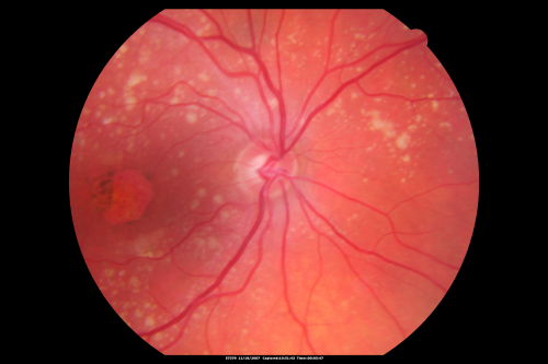 Small Retinal Pigment Epithelial Rip and Poor Vision (20/400)
80-year-old woman vision in the right eye has substantially declined.  
  OD:  20/400;  OS:  20/50
