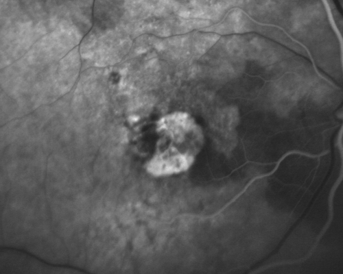 Small Retinal Pigment Epithelial Rip and Poor Vision (20/400)
80-year-old woman vision in the right eye has substantially declined.  
  OD:  20/400;  OS:  20/50
