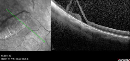 Retinoschisis - Superotemporally
Some line scans show RD and some showed retinoschisis.  Might have underlying RD that re-attached itself.
