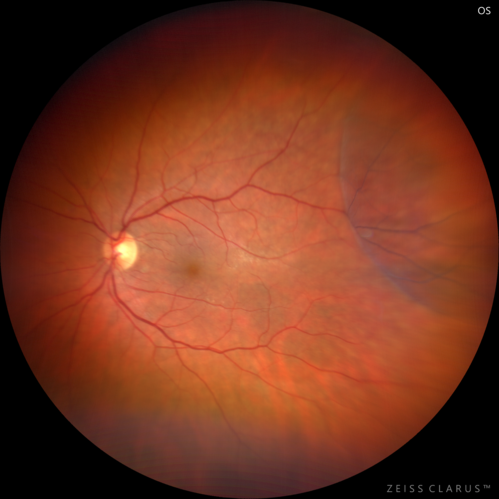 Retinoschisis - Confirmed with optical coherence tomography (OCT)
70 year old female with no visual complaints.  Retinoschisis is confirmed with OCT.  Eyes were stable when checked 8 months later.
