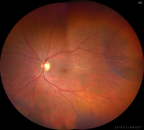 Retinoschisis - Confirmed with optical coherence tomography (OCT)
70 year old female with no visual complaints.  Retinoschisis is confirmed with OCT.  Eyes were stable when checked 8 months later.
