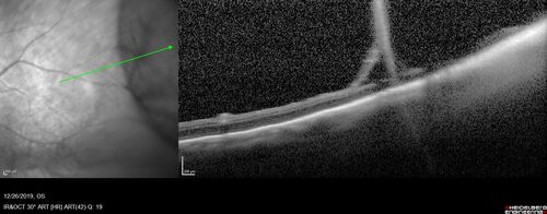 Retinoschisis - Confirmed with optical coherence tomography (OCT)
70 year old female with no visual complaints.  Retinoschisis is confirmed with OCT.  Eyes were stable when checked 8 months later.

