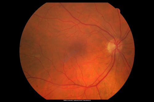 Bullous Retinoschisis - Confirmed with SD OCT
Atypical location for retinoschisis - SD-OCT is used to confirm that this is retinoschisis and not a retinal detachment
